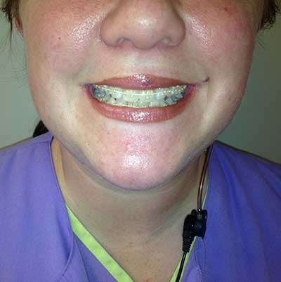 smiling patient with braces