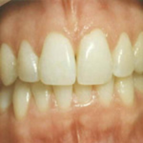 teeth before whitening